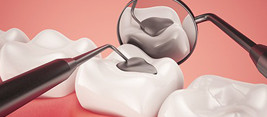 South Family Dental | South Calgary Dental Crowns & Fillings | Calgary Dental Crown Dentist