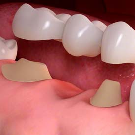 Dental Bridges