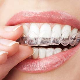 SE Calgary Invisalign Braces