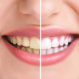 South Calgary Teeth Whitening, South Family Dental Care