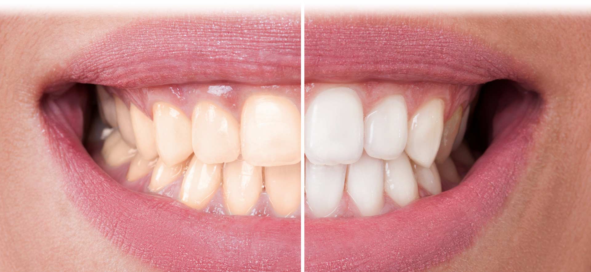 south-family-dental-teeth-whitening