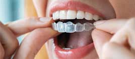 South Family Dental | South Calgary Invisalign | Calgary Invisalign Dentist